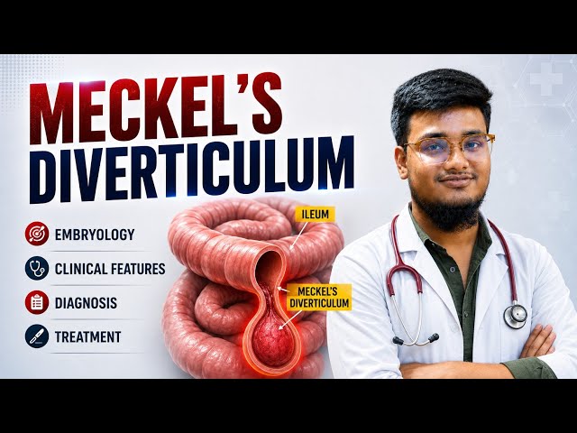 Meckel’s Diverticulum | Surgery Lecture | Clinical Features, Complications & Treatment | in hindi 