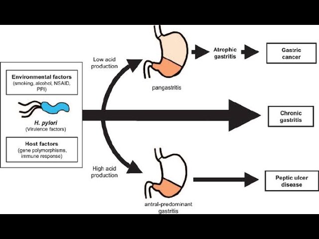 Pathogenesis of Acute Gastritis; Disruption of Mucosal Defenses, Aggressive Factors