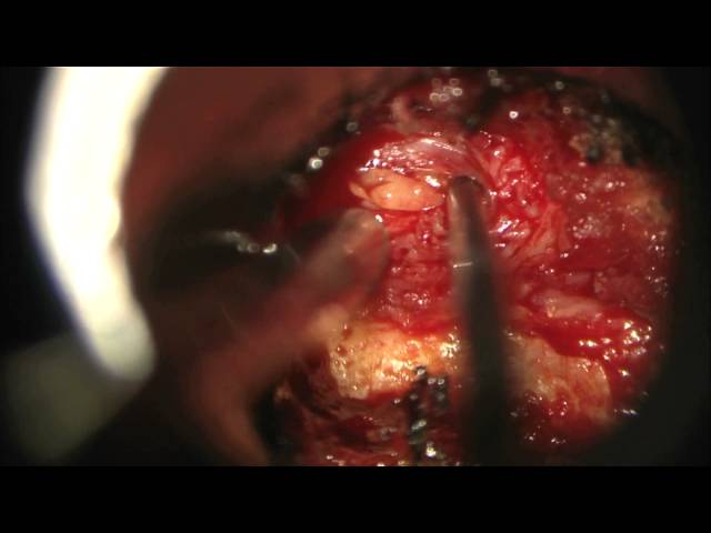 Minimally invasive surgery for lumbar microdiscectomy