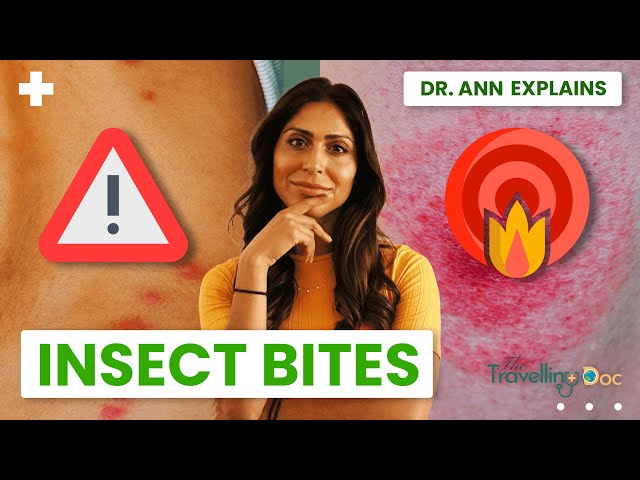 Insect Bites: How to Tell What Bit You (Pictures + When to Worry)#doctor #insectbite