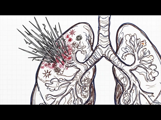Decoding Asbestos