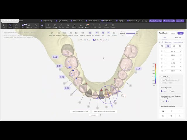 Complex OEM clear aligner case – closing a molar space with mesialization and bite correction