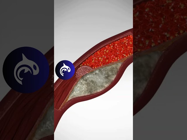See what a Heart Attack looks like in your body - 3D Animation #heart #heartattack #hearthealth