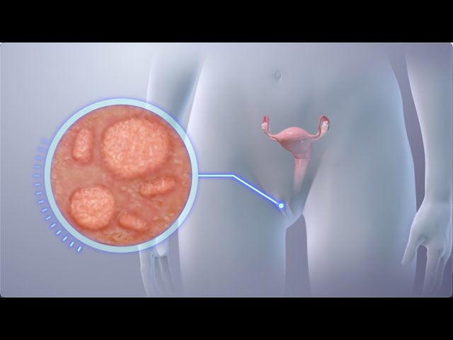Herpes genital en la mujer