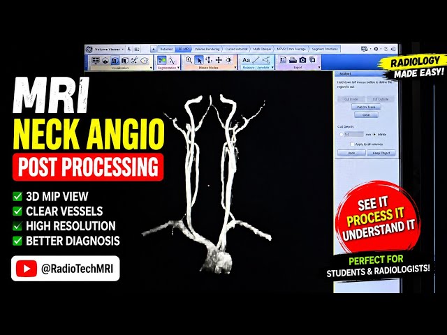 MRI Neck Angiography Post Processing | Step-by-Step 3D MIP & Volume Rendering Tutorial