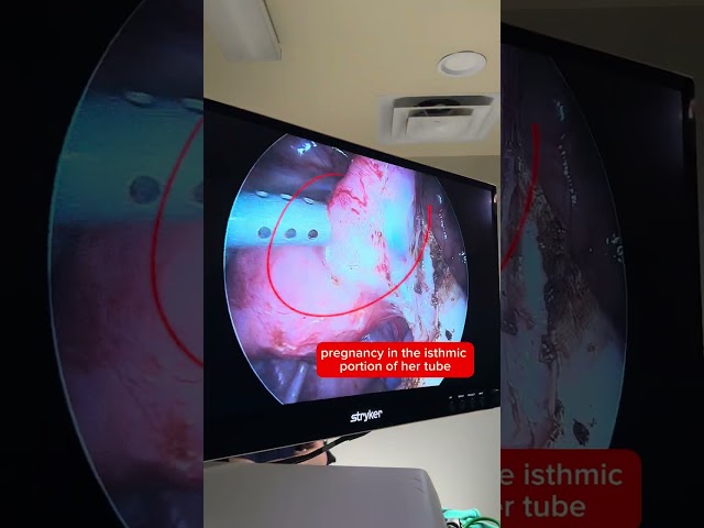 Dangerous Ectopic Pregnancy‼️