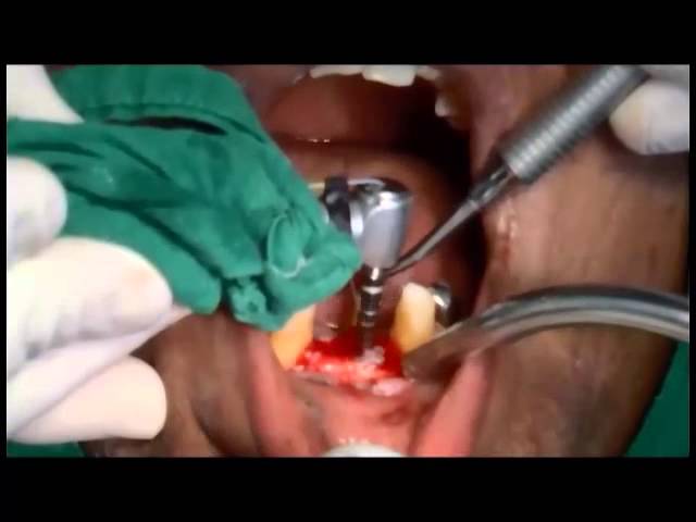 Placement of Dental Implant in Anterior Mandibular Region