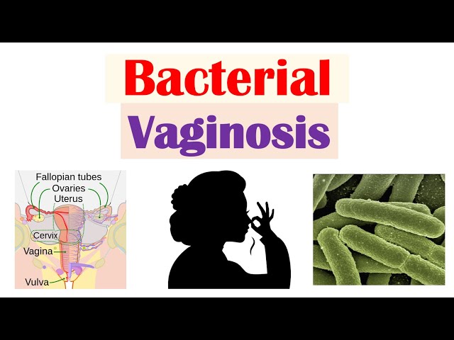Bacterial Vaginosis (Vaginal Infection): Causes, Risk Factors, Symptoms, Diagnosis, Treatment