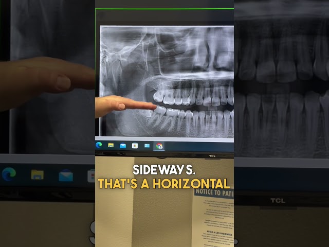 🚨 Do you have impacted wisdom teeth? Let’s talk about what it means… #wisdomteeth