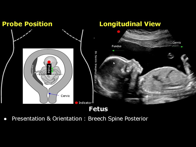Posicionamiento de la sonda de ultrasonido obstétrico | Colocación del transductor en el útero y ...