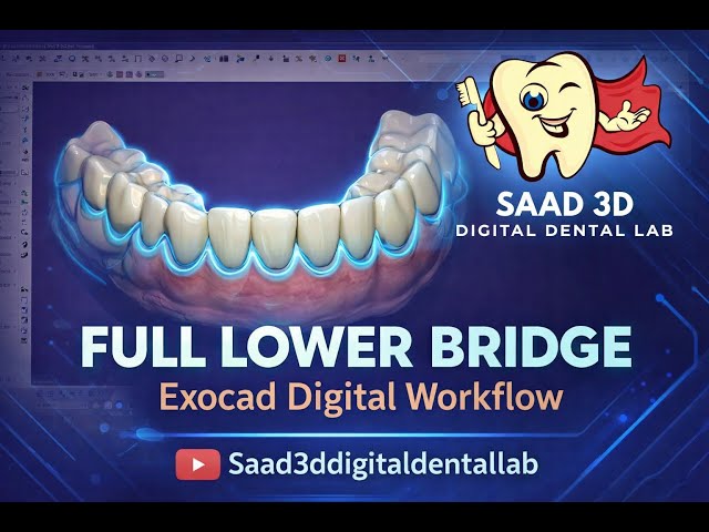 Lower Full Bridge Design in Exocad | Complete Digital Workflow | Dental CAD CAM