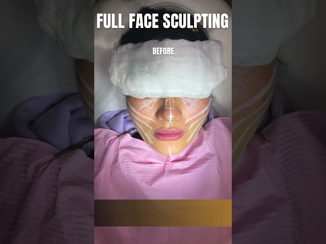 Full Face Sculpting: Transform Your Look! | Dr Adarsh Tripathi - Sarayu Clinics