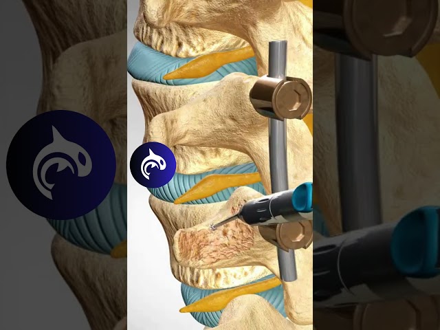 See how a Lumbar Fusion of the Spine works in 3D animation #backpain #stem #spine