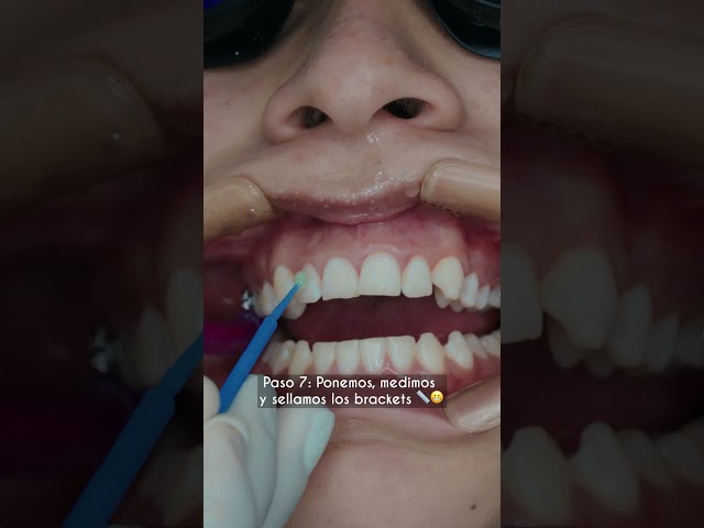 Cómo se ponen los brackets 🤔 Odontología Láser #shorts