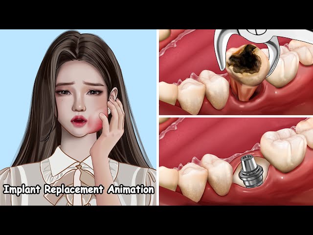 ASMR Implant Replacement Animation - Deep Cleaning Treatment