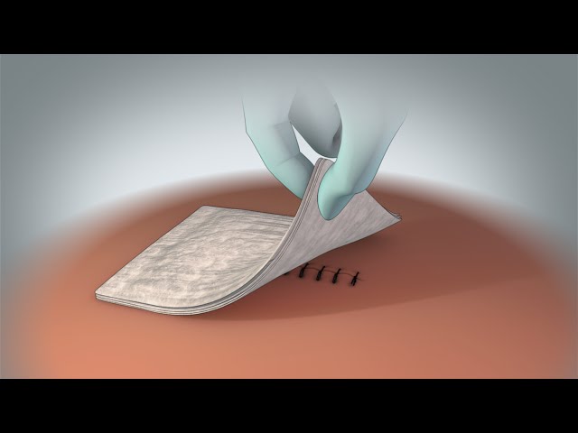 Incision Care Discharge Instructions | Nucleus Health