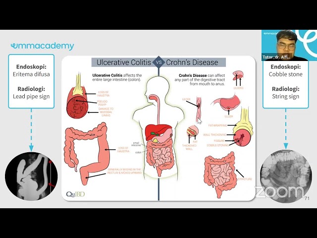 Free Class Medicademy : UKMPPD Class - Gastrointestinal Tract