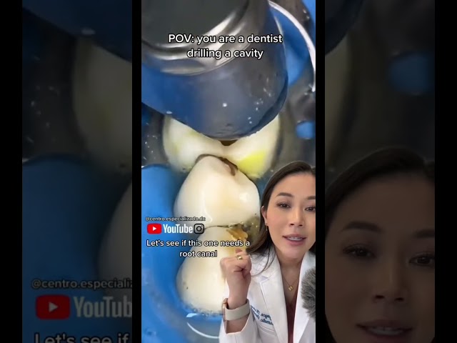 Another gigantic cavity being cleaned and filled. Catch the rest of my TikTok! #cavity #filling