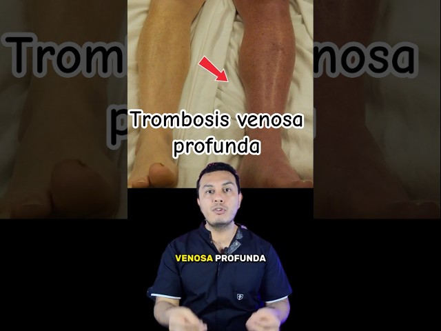 Trombosis venosa profunda (TVP)  #medicina  #datoscurisos #tvp