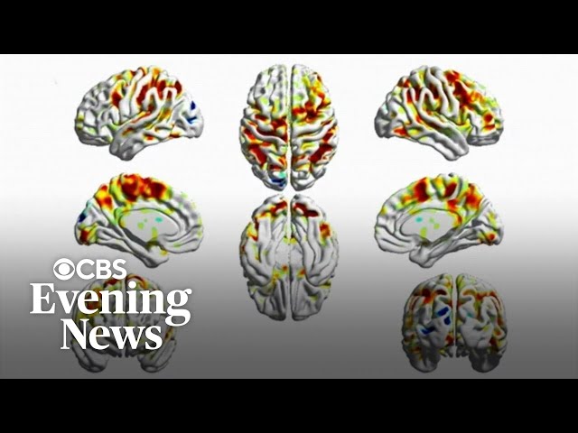 How smartphone addiction may be hurting our brains