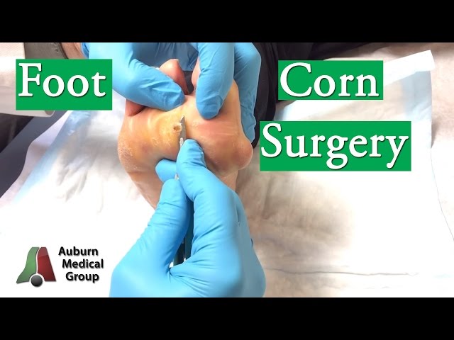 Foot Corn Surgery Treatment
