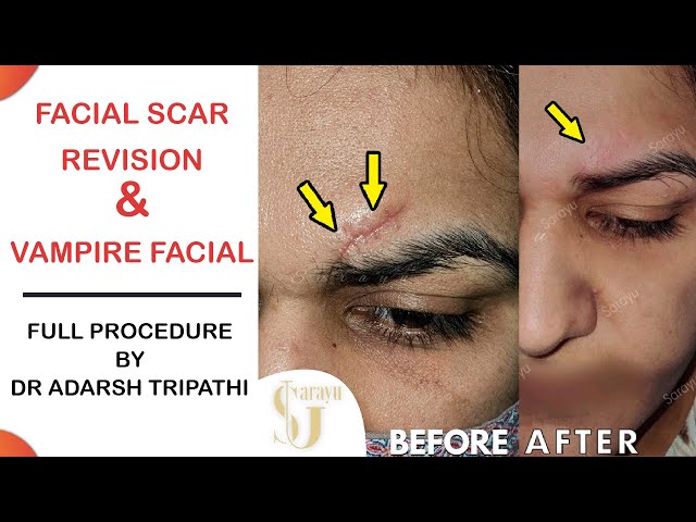 Facial Scar Revision & Vampire Facial ( Before After) | Dr Adarsh Tripathi