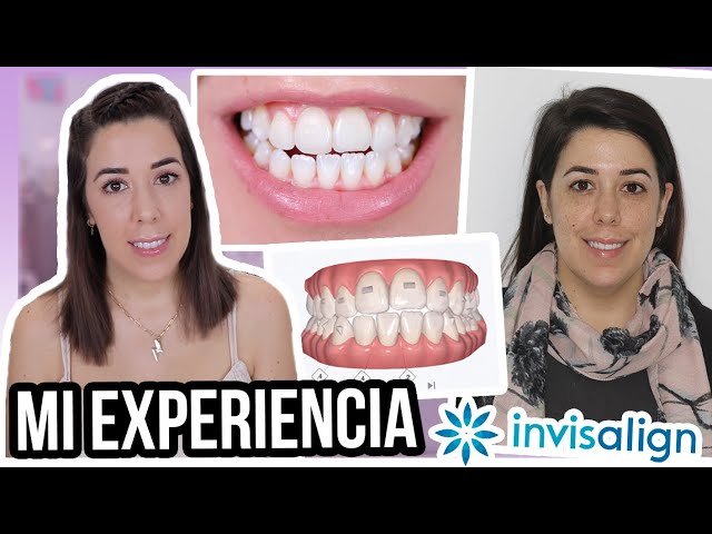 Mi experiencia con INVISALIGN | ¿CUÁNTO CUESTA? ¿TIEMPO? ¿ESTOY CONTENTA?
