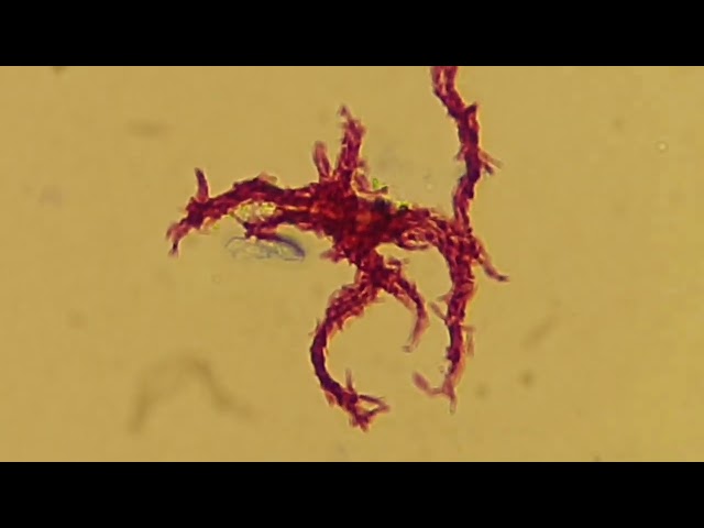 Serpentine cord of MTBC from liquid culture Z- N and Auramine-Rhodamine staining