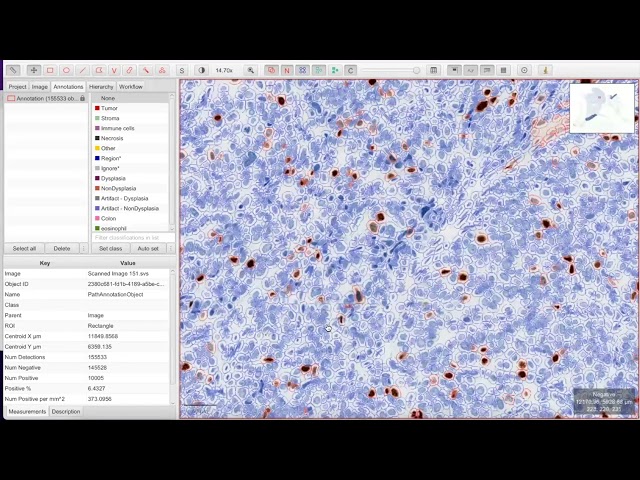 QuPath 101: Ki67 Quantification