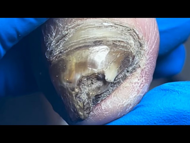 Dark Black Toenails, Cut Off The Hard Outer Shell!【Pedicure Master Lin Jun】