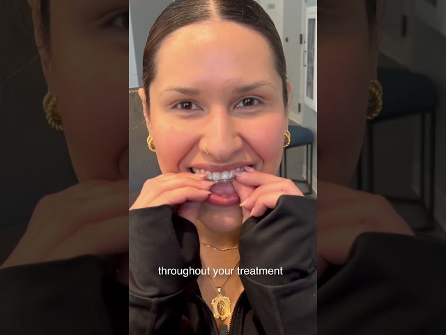 Why Some People Choose Invisalign Over Braces 🦷