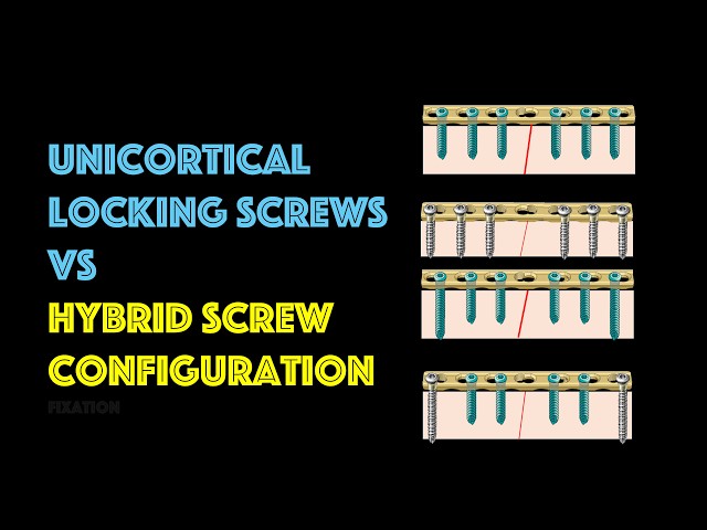 Unicortical Locking Screws VS Hybrid Screw Construct