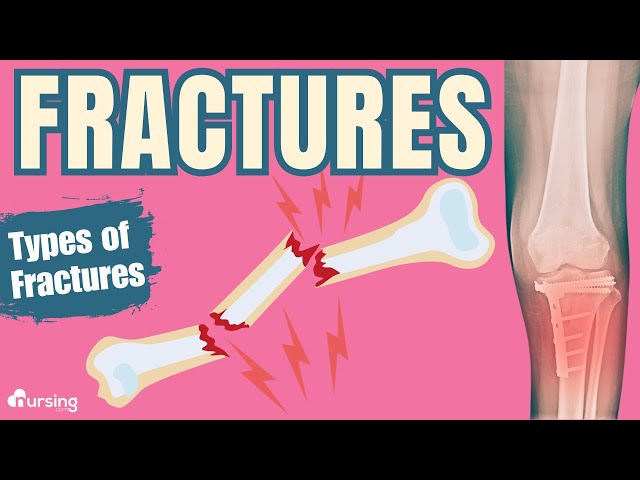 Bone Fractures- Types of Fractures- Nursing