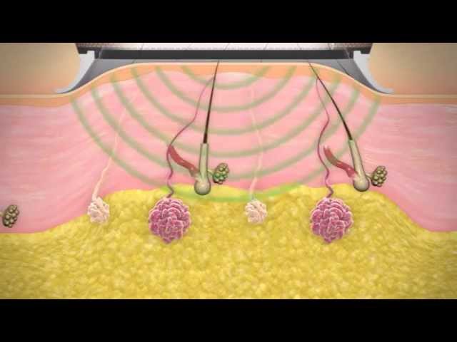 miraDry Me -  How underarm sweat treatment works