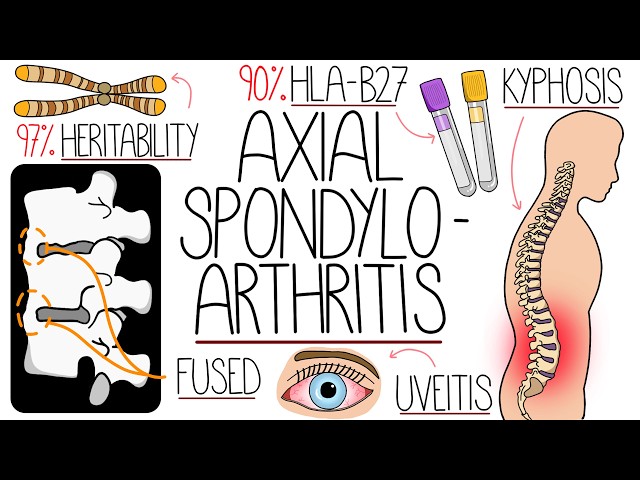 Understanding Axial Spondyloarthritis (Ankylosing Spondylitis)