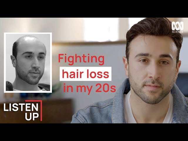 “I Started Losing My Hair At 20”