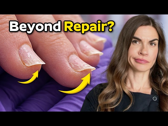 Nails So Thin They Curl Up (& How to Fix it)