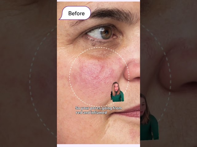 How to Make Large Pores Look Smaller: Azelaic Acid & Salicylic Acid