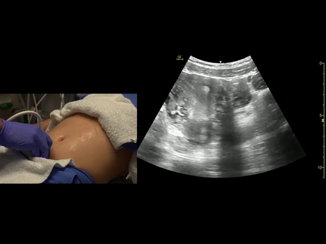 Transabdominal Pelvis Ultrasound Scanning Techniques