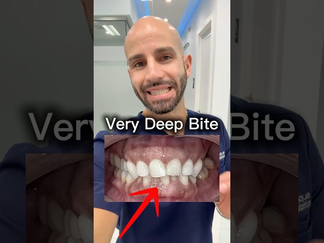 Can Invisalign Fix a Very Deep Bite in Adults? See 9-Month Progress!