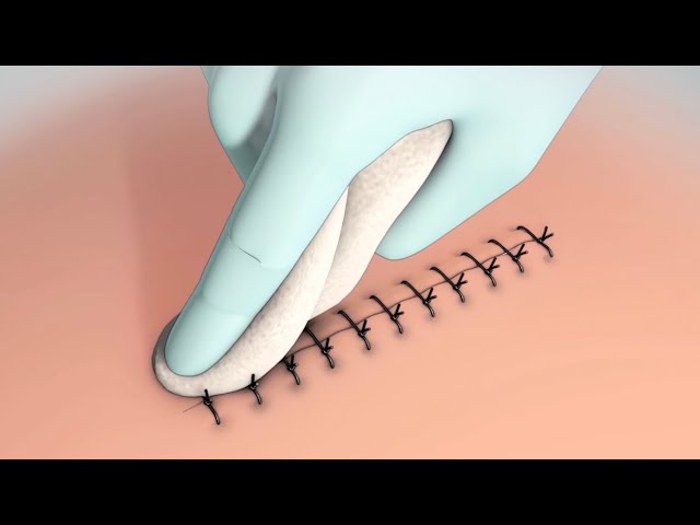 Discharge instructions for incision care