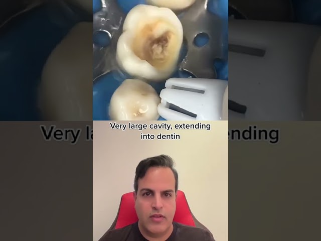BIG cavity removal step-by-step #Tooth #Dentistry #decay#Shorts#Teeth #Cavity