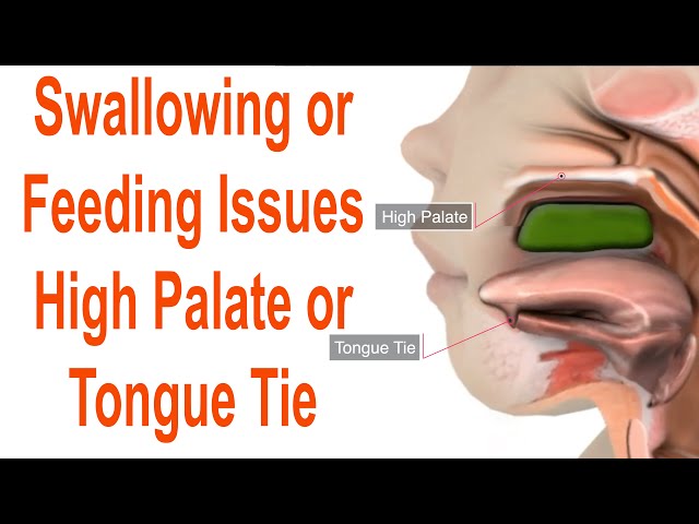 Feeding Or Swallowing Problems Due to High Plate or Tongue Tie