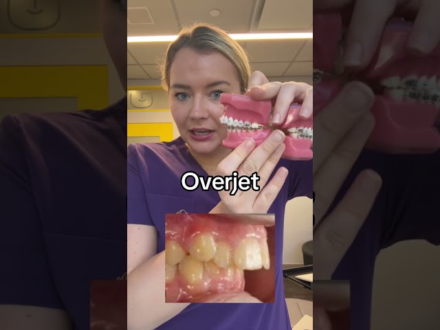 Overjet vs overbite #braces #overbite #overjet