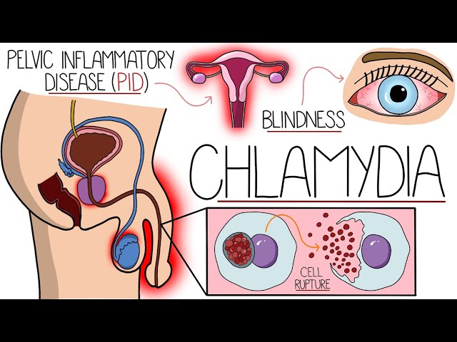 Understanding Chlamydia (Chlamydia Trachomatis Explained Clearly)