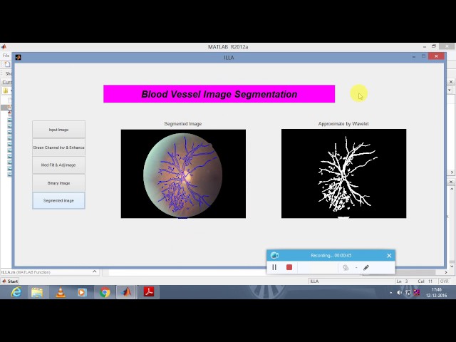 Automated Vessel Segmentation Using Infinite Perimeter Active Contour Model on Retinal Images