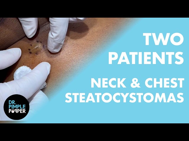 What are These Neck & Chest Bumps? | Dr. Pimple Popper Helps Two Steatocystoma Patients