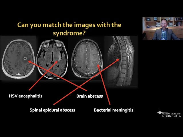 Virtual Resident Education Lecture Series: Neuroinfectious Diseases - American Academy of Neurology