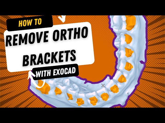 Removing Ortho Brackets Using Exocad