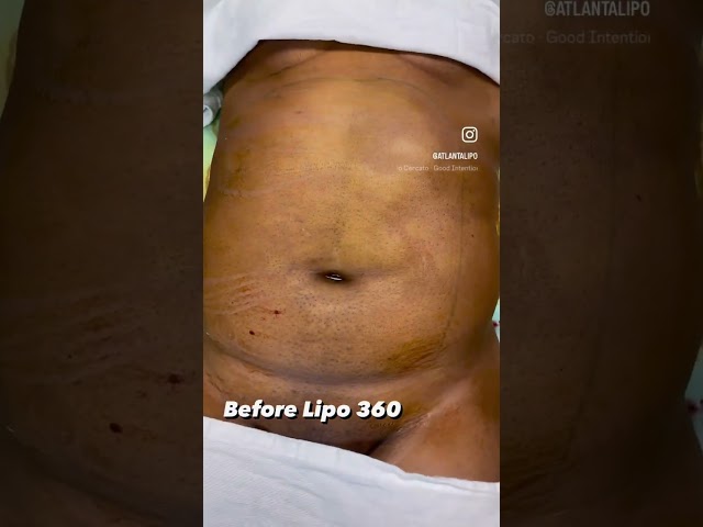 Lipo 360 under local anesthesia! #lipo360 #cosmeticsurgery #atlanta #atlantaliposuction 770-416-0000